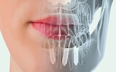 10.1. INICIO EN IMPLANTOLOGIA ORAL PARA EL ODONTOLOGO GENERAL